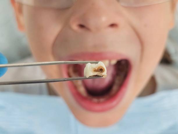 Best Emergency Treatment for Toothache in Cahokia, IL